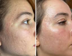 April Promotion: Acne Laser 30% OFF - Monarch MD Medical Aesthetics