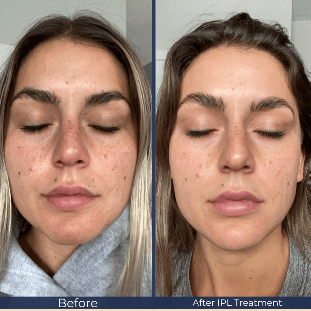 January Promotion: IPL Photo - Rejuvenation - Monarch MD Medical Aesthetics
