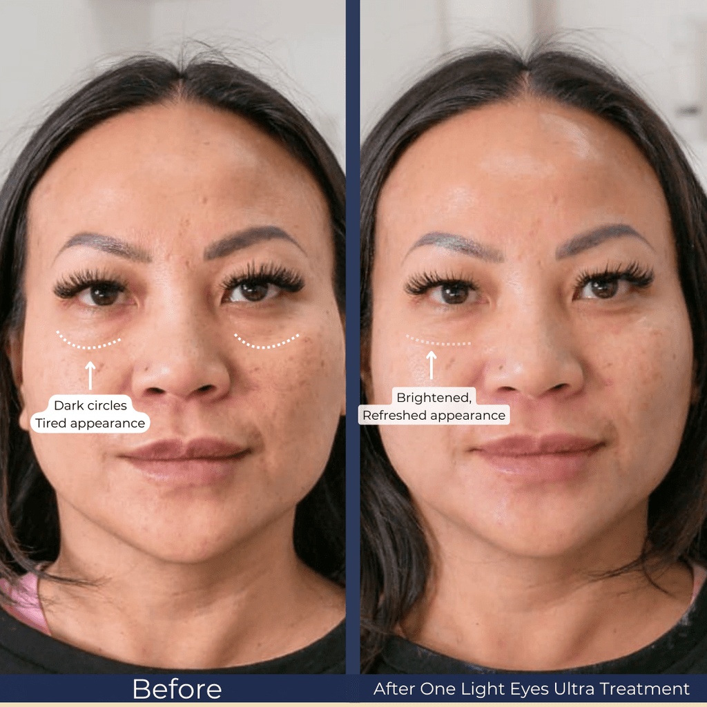 Light Eyes Rejuvenation Special - Monarch MD Medical Aesthetics