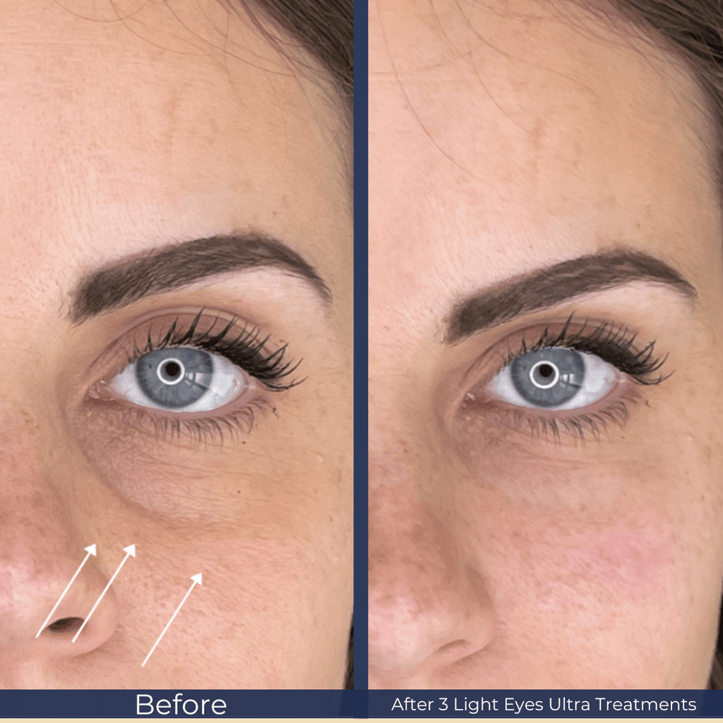 Light Eyes Rejuvenation Special - Monarch MD Medical Aesthetics
