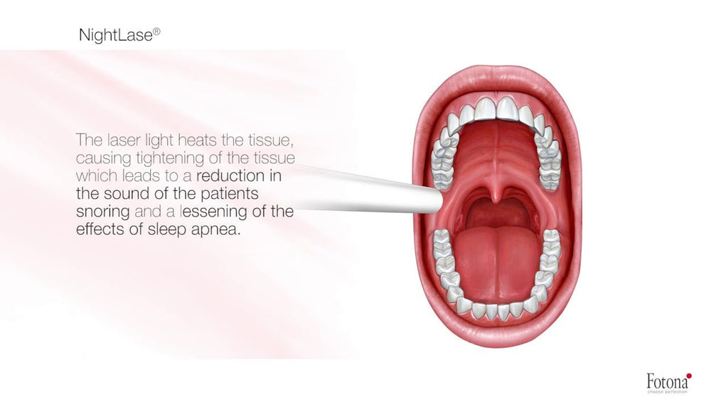 Nightlase (Snoring and Sleep Quality Laser Treatment) (BUY 3, GET 3 FREE SEPTEMBER PROMO) - Monarch MD Medical Aesthetics by Double Board Certified Facial Plastic Surgeon Dr. Eli Akbari MD, FRCSC