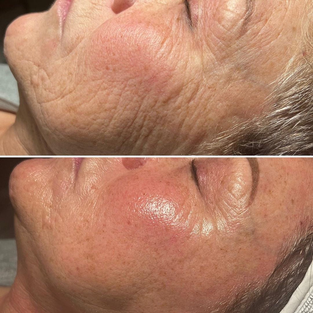 Youthful Swich Facial - Monarch MD Medical Aesthetics