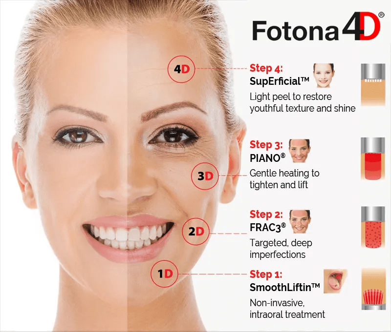 Fotona 4D Laser Facelift - Monarch MD Medical Aesthetics by Double Board Certified Facial Plastic Surgeon Dr. Eli Akbari MD, FRCSC
