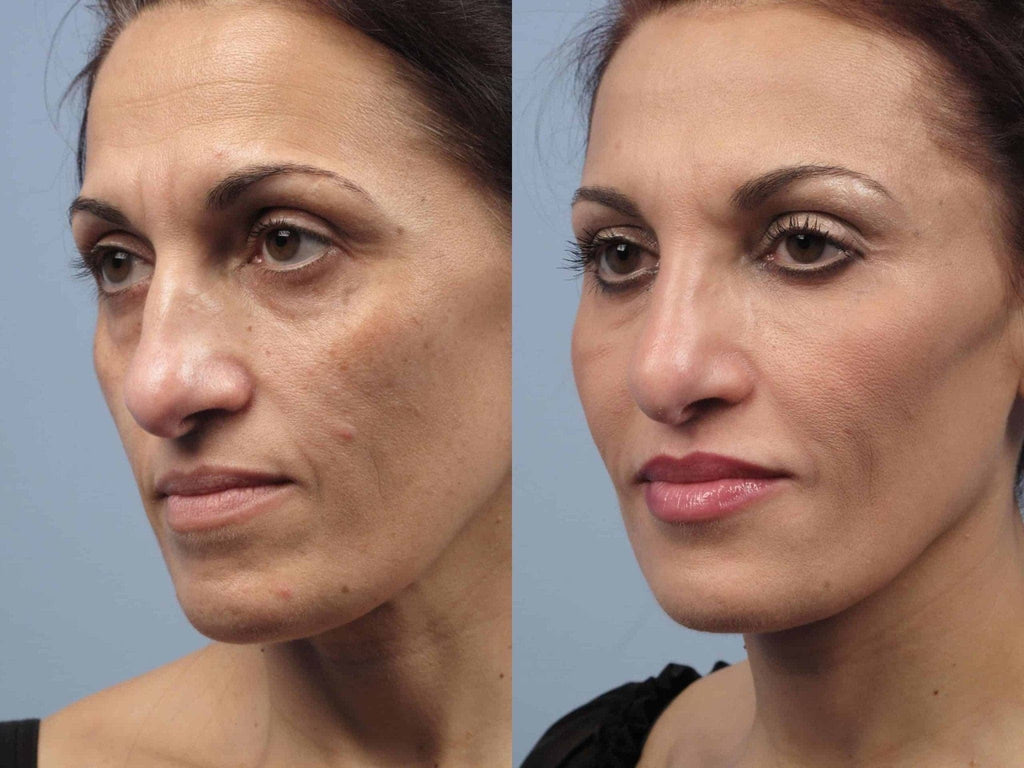 Fotona Fractional Resurfacing - Monarch MD Medical Aesthetics by Double Board Certified Facial Plastic Surgeon Dr. Eli Akbari MD, FRCSC