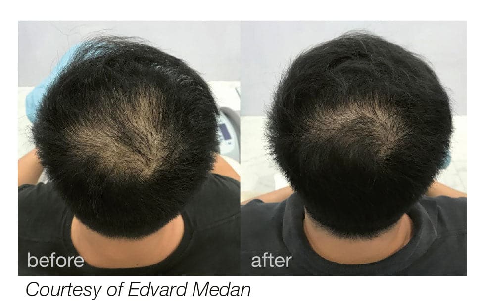 Fotona HAIRestart (Laser Hair Regrowth Treatment) - Monarch MD Medical Aesthetics by Double Board Certified Facial Plastic Surgeon Dr. Eli Akbari MD, FRCSC