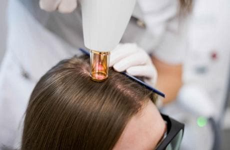Fotona HAIRestart (Laser Hair Regrowth Treatment) - Monarch MD Medical Aesthetics by Double Board Certified Facial Plastic Surgeon Dr. Eli Akbari MD, FRCSC