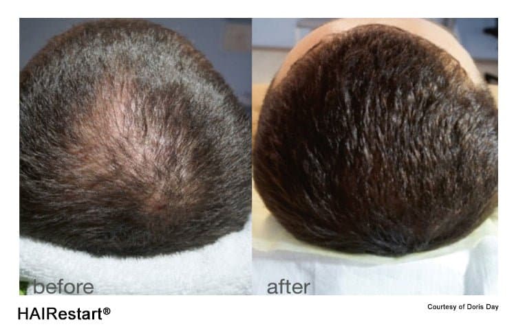 Fotona HAIRestart (Laser Hair Regrowth Treatment) - Monarch MD Medical Aesthetics by Double Board Certified Facial Plastic Surgeon Dr. Eli Akbari MD, FRCSC