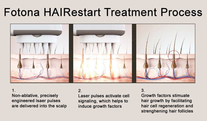 Fotona HAIRestart (Laser Hair Regrowth Treatment) - Monarch MD Medical Aesthetics by Double Board Certified Facial Plastic Surgeon Dr. Eli Akbari MD, FRCSC