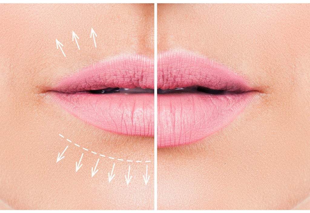 Fotona LipLase - Monarch MD Medical Aesthetics by Double Board Certified Facial Plastic Surgeon Dr. Eli Akbari MD, FRCSC