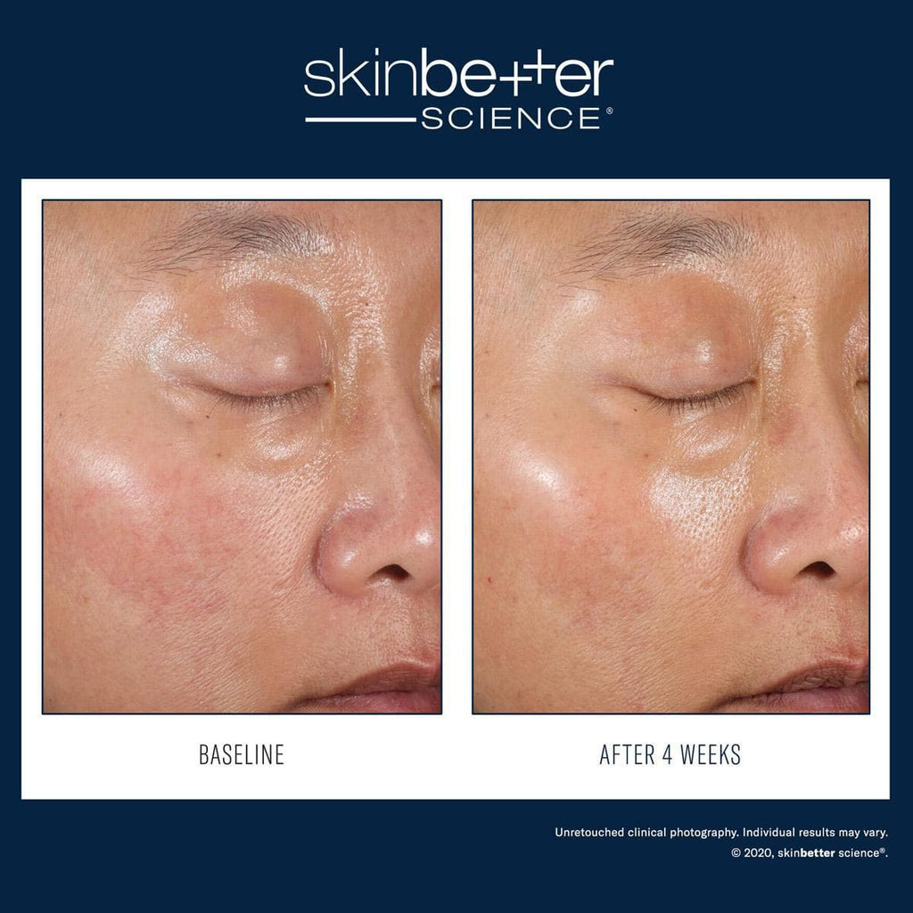 Skinbetter Science - A-Team Duo Kit - Monarch MD Medical Aesthetics by Double Board Certified Facial Plastic Surgeon Dr. Eli Akbari MD, FRCSC