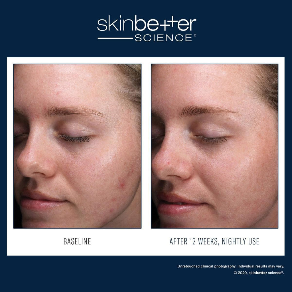 Skinbetter Science - AlphaRet Clearing Serum - Monarch MD Medical Aesthetics by Double Board Certified Facial Plastic Surgeon Dr. Eli Akbari MD, FRCSC