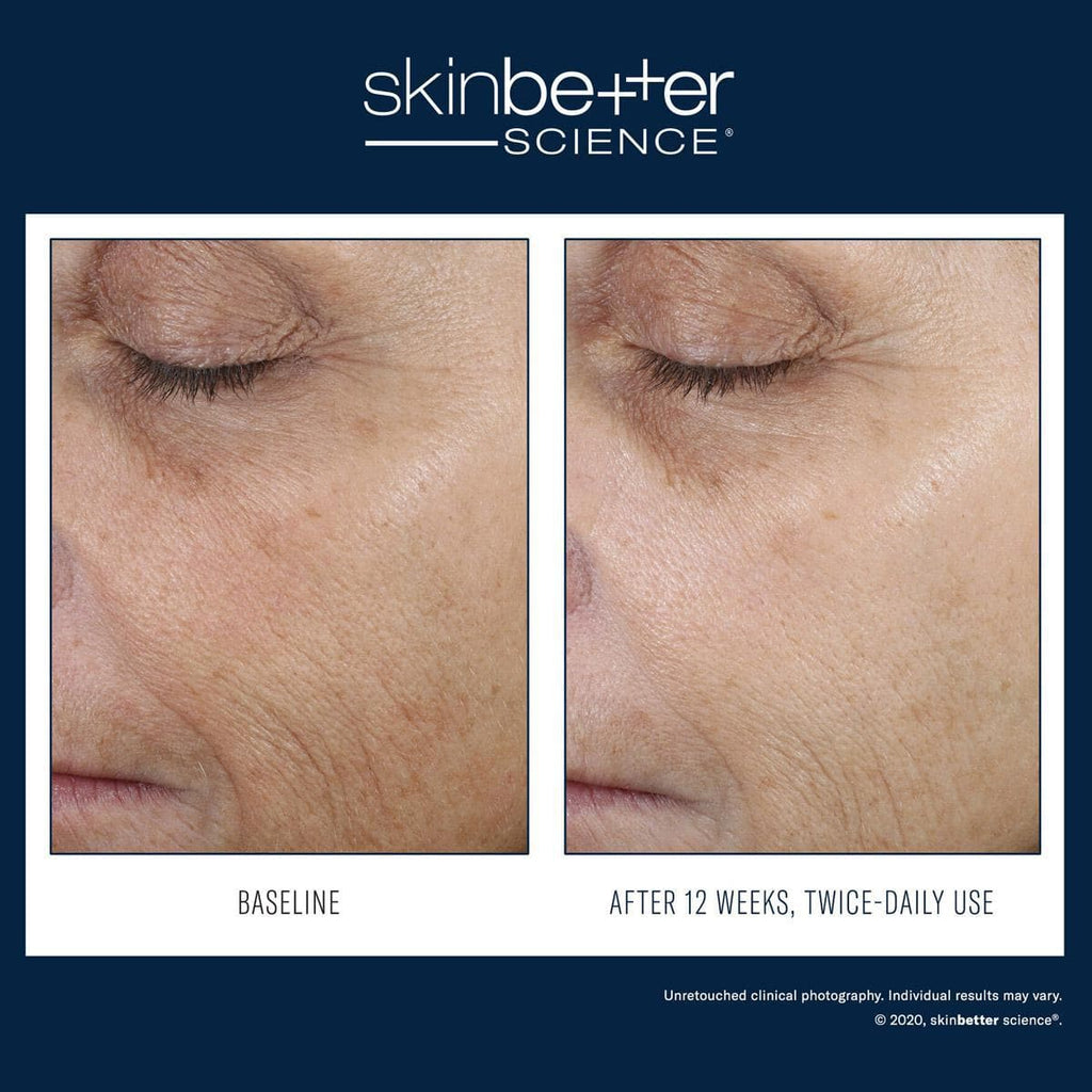 Skinbetter Science - Even Tone Correcting Serum Face - Monarch MD Medical Aesthetics by Double Board Certified Facial Plastic Surgeon Dr. Eli Akbari MD, FRCSC