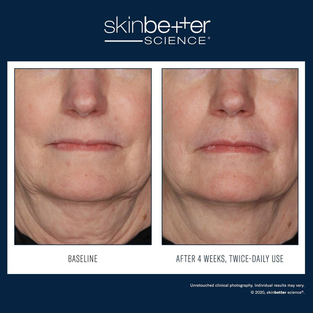 Skinbetter Science - Interfuse Treatment Cream Face & Neck - Monarch MD Medical Aesthetics by Double Board Certified Facial Plastic Surgeon Dr. Eli Akbari MD, FRCSC