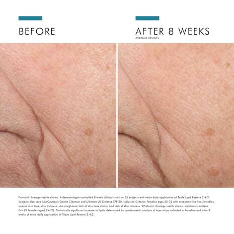SkinCeuticals Triple Lipid Restore 2:4:2 - Monarch MD Medical Aesthetics by Double Board Certified Facial Plastic Surgeon Dr. Eli Akbari MD, FRCSC