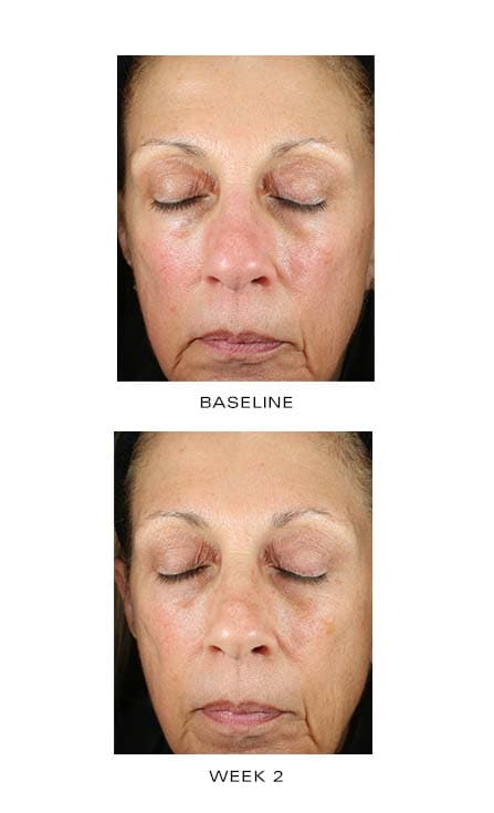 ZO Renewal Creme - Monarch MD Medical Aesthetics by Double Board Certified Facial Plastic Surgeon Dr. Eli Akbari MD, FRCSC